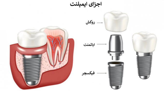 مراحل کاشت ایمپلنت دندان